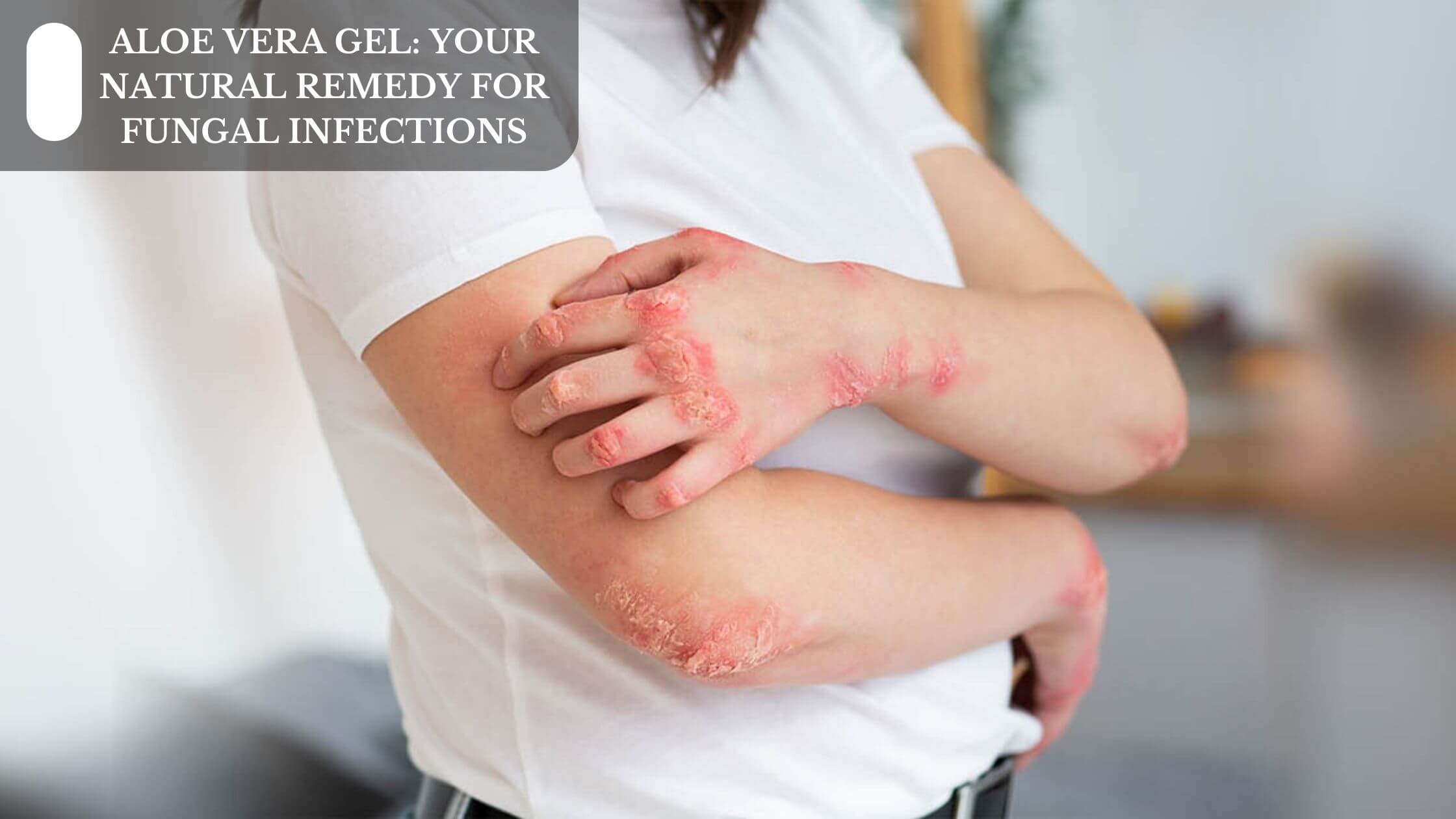 Aloe Vera Gel Your Natural Remedy For Fungal Infections Moksha