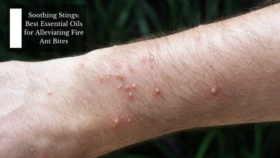 Soothing Stings: Best Essential Oils for Alleviating Fire Ant Bites