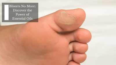 Blisters No More: Discover the Power of Essential Oils