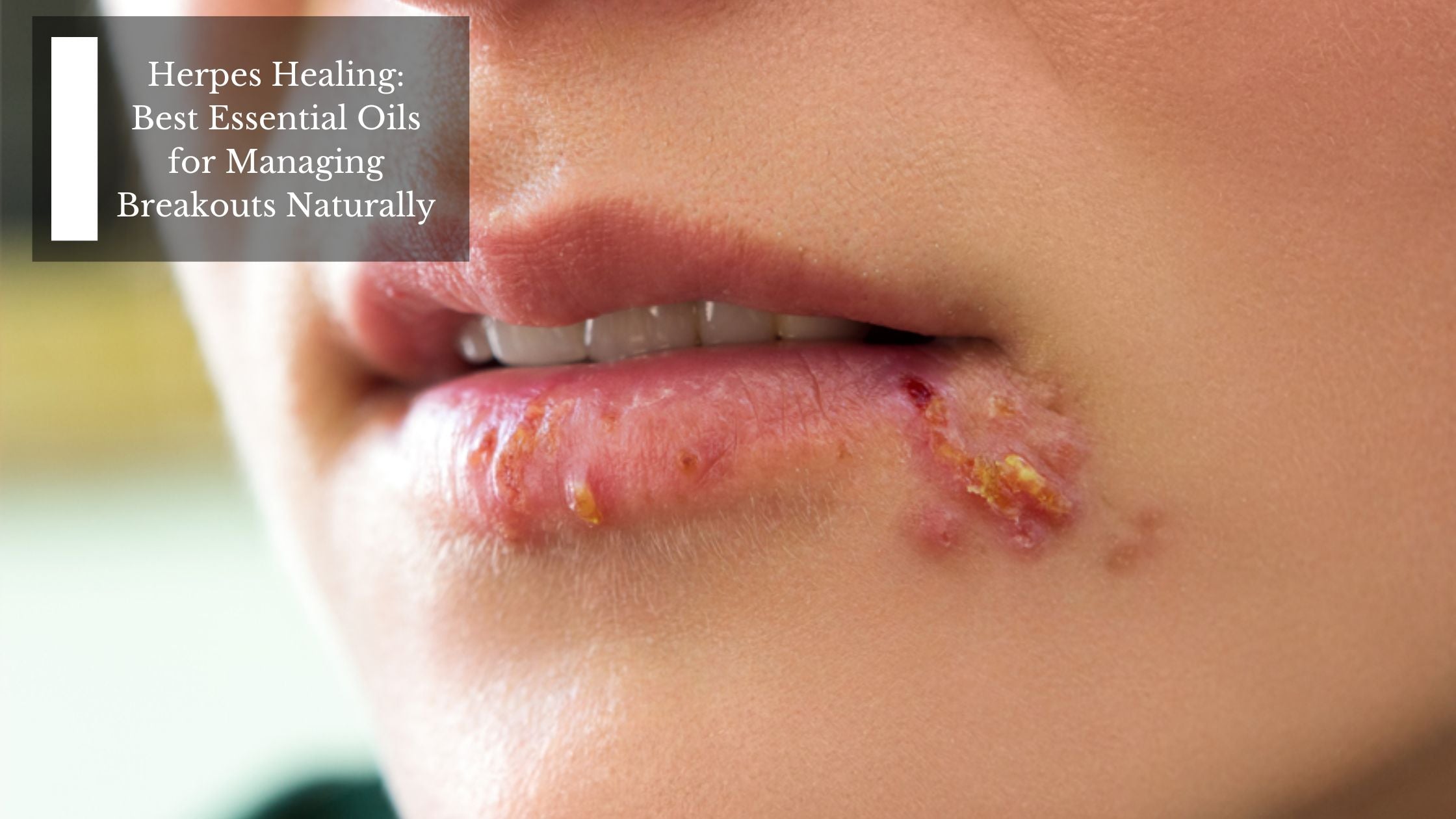 Herpes Healing Best Essential Oils for Managing Breakouts Naturally Moksha Essentials Inc.