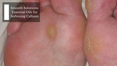 Smooth Solutions: Essential Oils for Softening Calluses